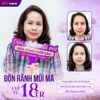 ĐỘN RÃNH MŨI MÁ